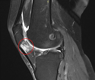 MRI van de knie met ontsteking in het vetlichaam van Hoffa