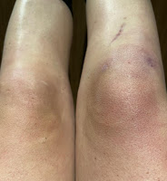 Een knie met vocht na voorste kruisbandreconstructie