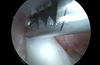 Beeld van arthroscopie in de knie
