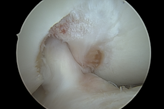 Binnenzijde van de knie na notchplastiek
