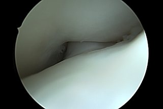 Knie na notchplastiek, extensie wordt behaald