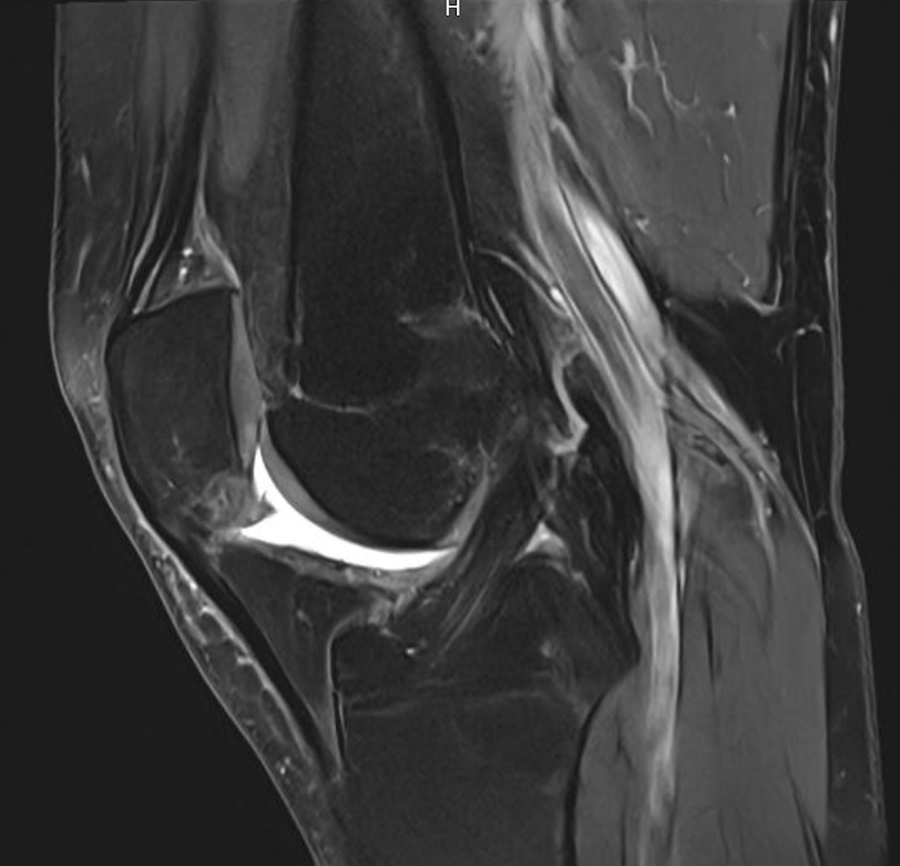 MRI scan artrofibrose knie